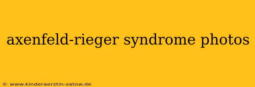 axenfeld-rieger syndrome photos