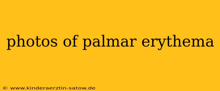 photos of palmar erythema