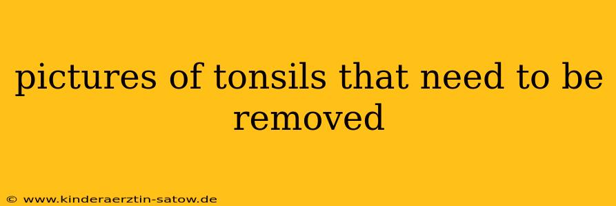 pictures of tonsils that need to be removed